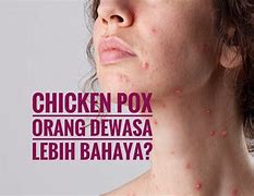 Apa Artinya Chicken Pox